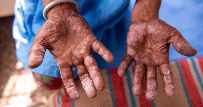 Ministrul sănătății confirmă un caz de lepră la Spitalul din Cluj