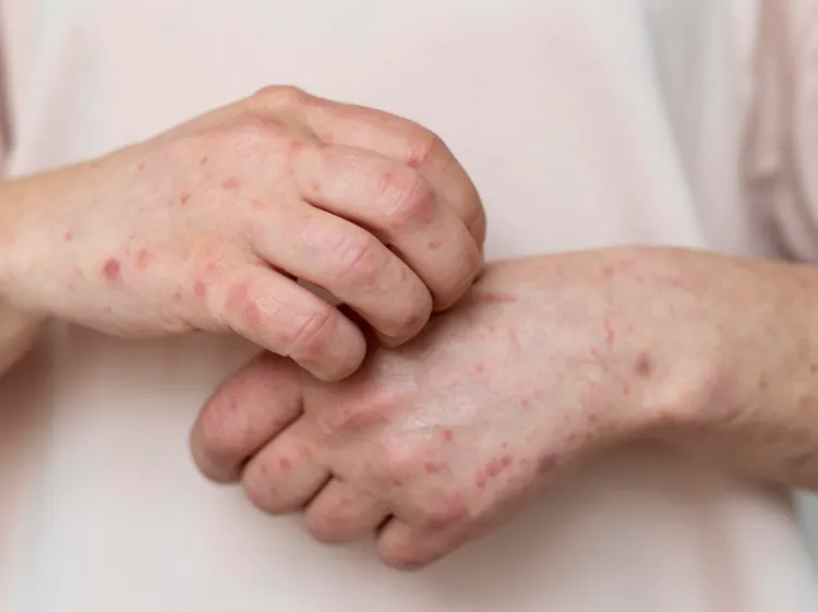 Confirmare și investigare a cazurilor de lepră la un salon din Cluj-Napoca