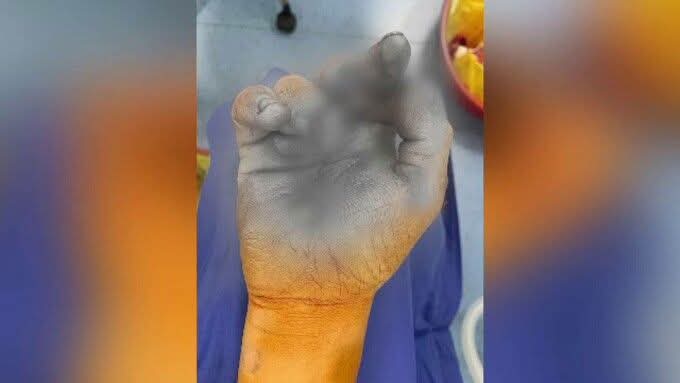 Doi copii răniți în urma exploziei unei petarde în comuna Mircea-Vodă, Brăila