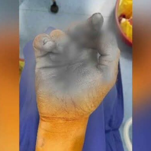 Doi copii răniți în urma exploziei unei petarde în comuna Mircea-Vodă, Brăila