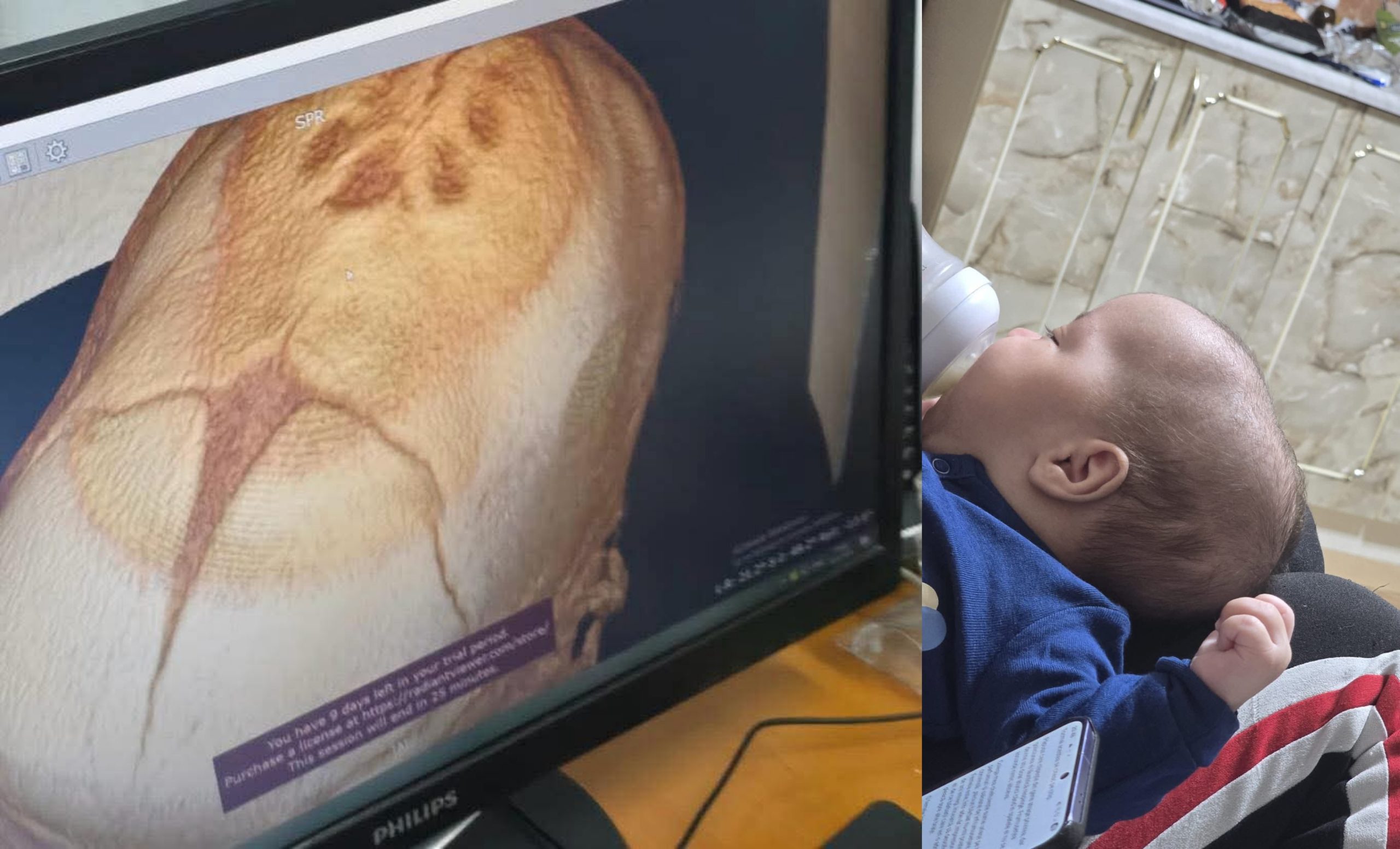 Sindicatul Europol solicită sprijin pentru bebelușul Teodor cu craniostenoză