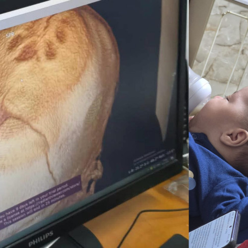 Sindicatul Europol solicită sprijin pentru bebelușul Teodor cu craniostenoză