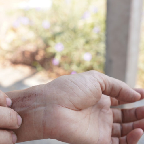 Direcția de Sănătate Publică Timiș verifică cazurile de scabie la Spitalul de Psihiatrie Jebel