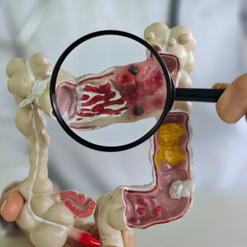 Specialiștii analizează probe de cancer intestinal de până la un secol pentru a înțelege creșterea cazurilor la tineri