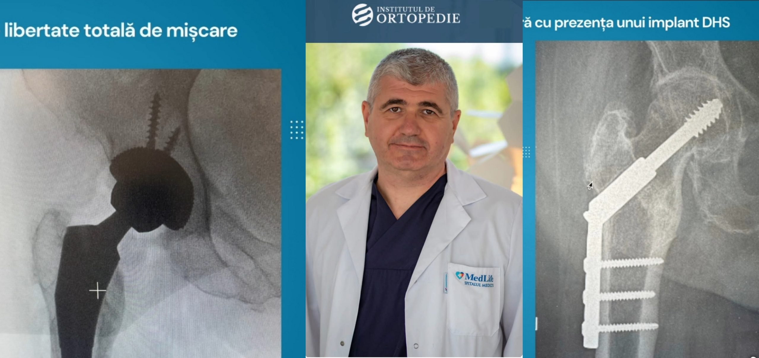 Chirurgul Bogdan Niculescu realizează o operație complexă de șold