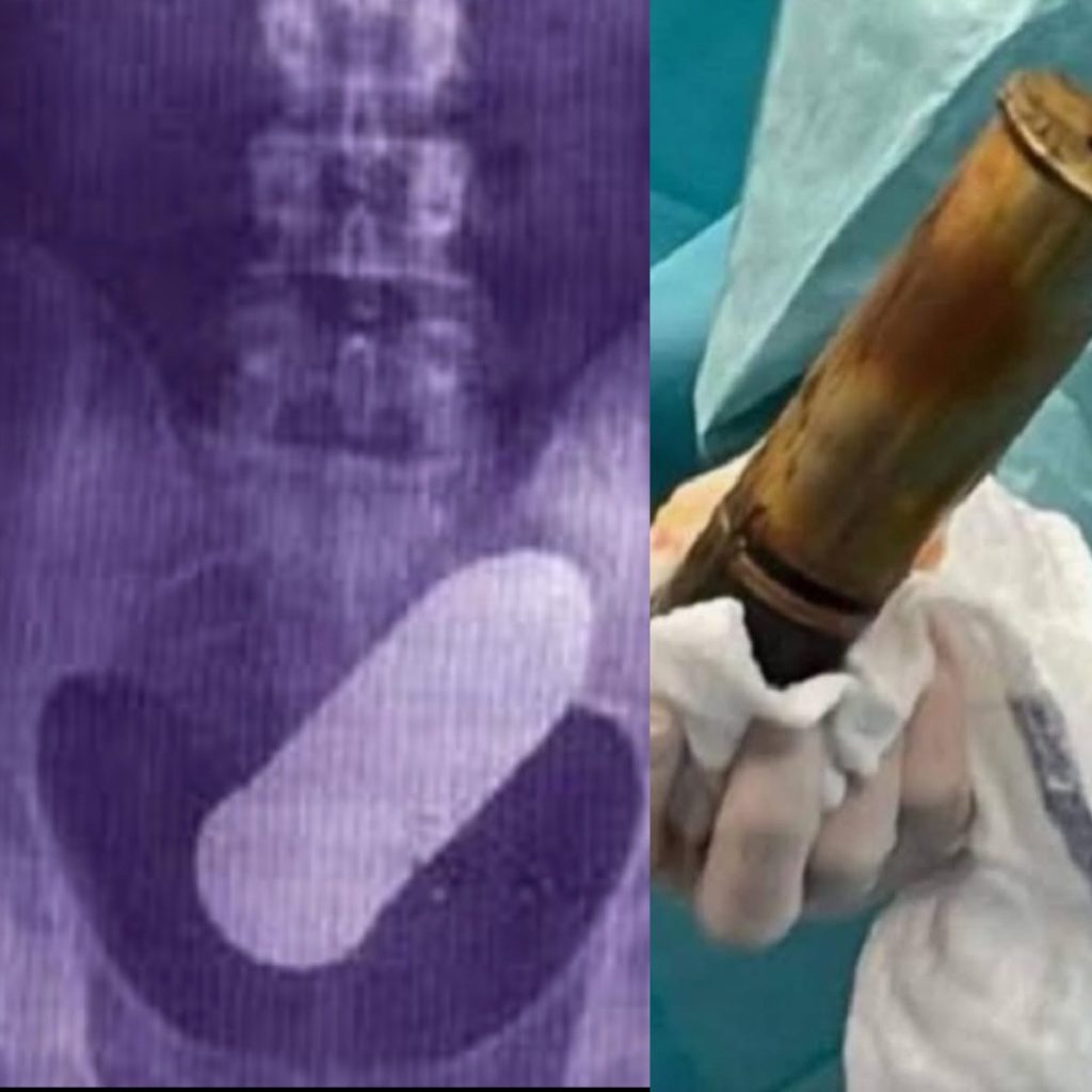 Evadarea de urgență a unui spital din Toulouse din cauza unui proiectil istoric