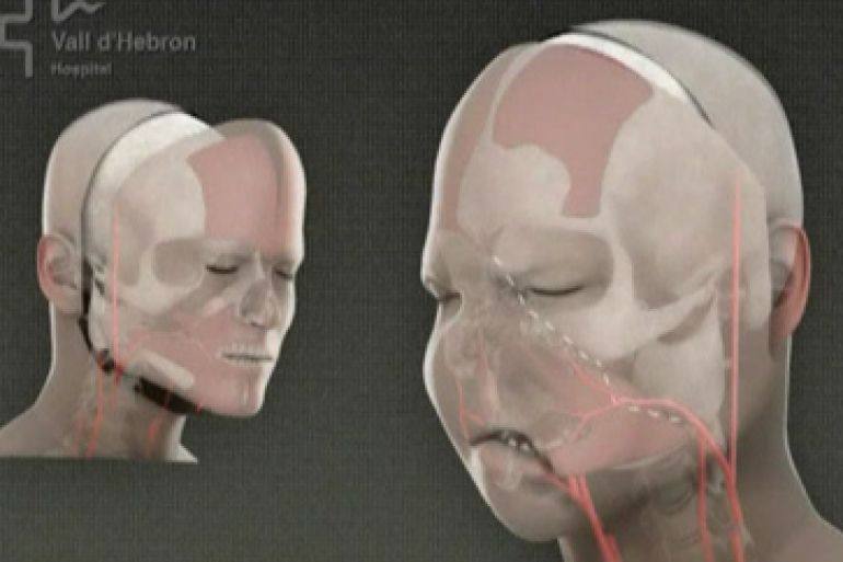 Primul transplant parțial de față din lume de la o donatoare cu moarte asistată