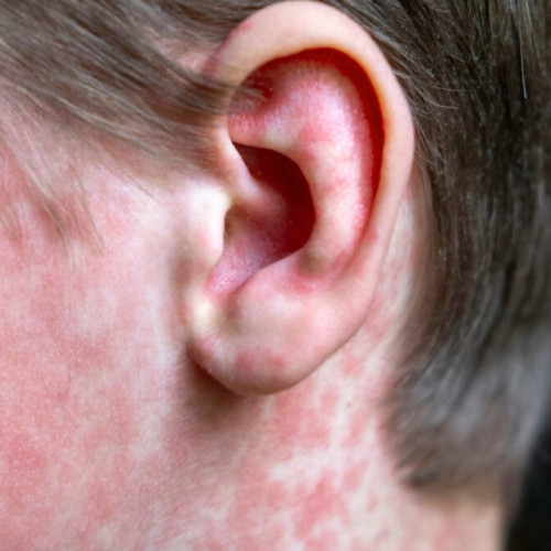 CDC refuză să își asume vina pentru revenirea rujeolei