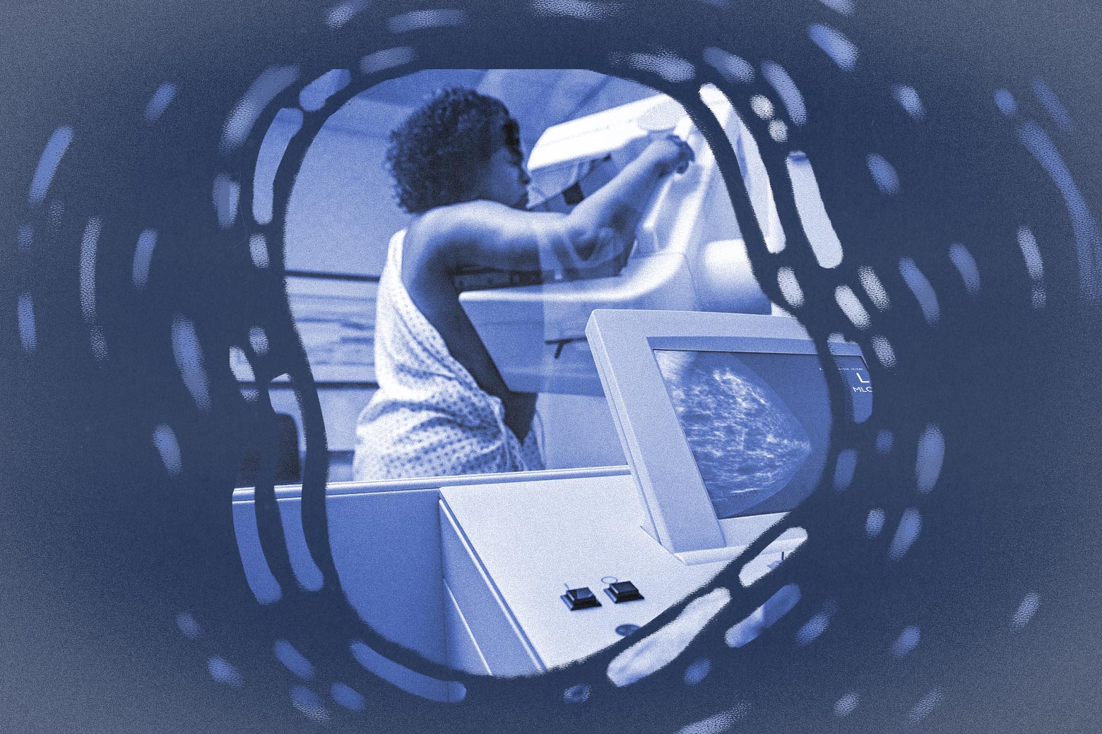It’s the Gold Standard of Early Cancer Detection. For 40 Percent of Women, It Doesn’t Work. - Slate
