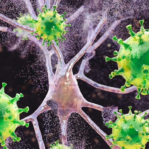 Complicații grave apărute în epidemia de rujeolă din Carolina de Sud