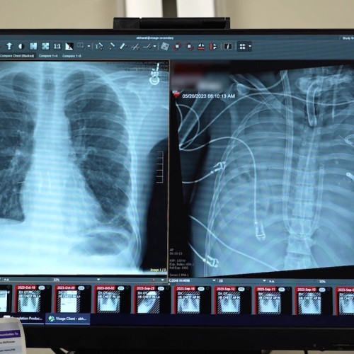 Chirurgii mențin în viață un bărbat fără plămâni, deschizând o nouă cale pentru transplant