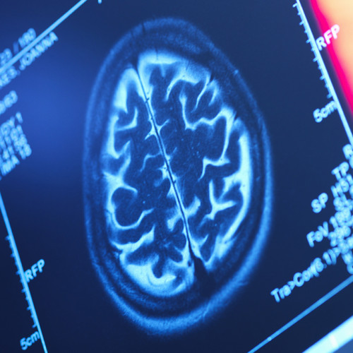 Modele ascunse ale grăsimii corporale ar putea reduce volumul creierului, arată un studiu