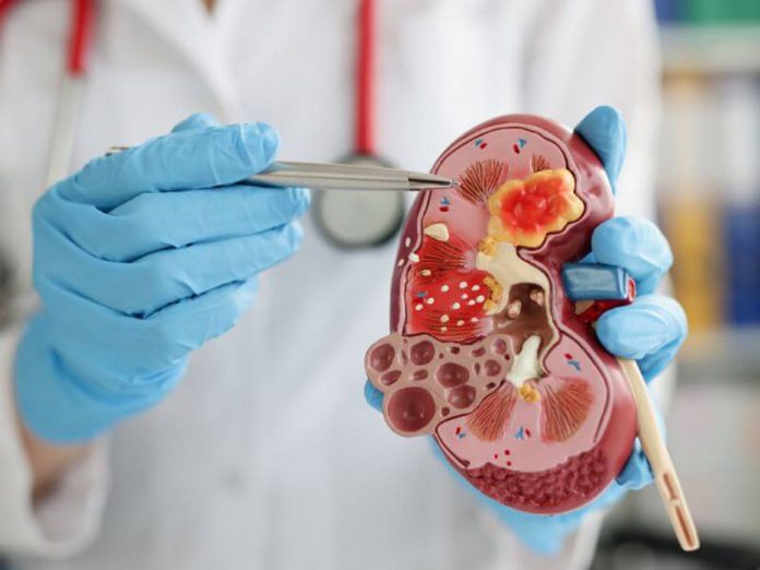 Studiu revoluționar: Pietrele la rinichi conțin bacterii vii, nu doar minerale