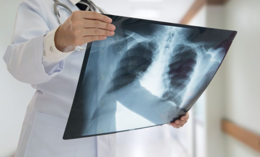 Numărul deceselor cauzate de pneumonie continuă să crească în 2026