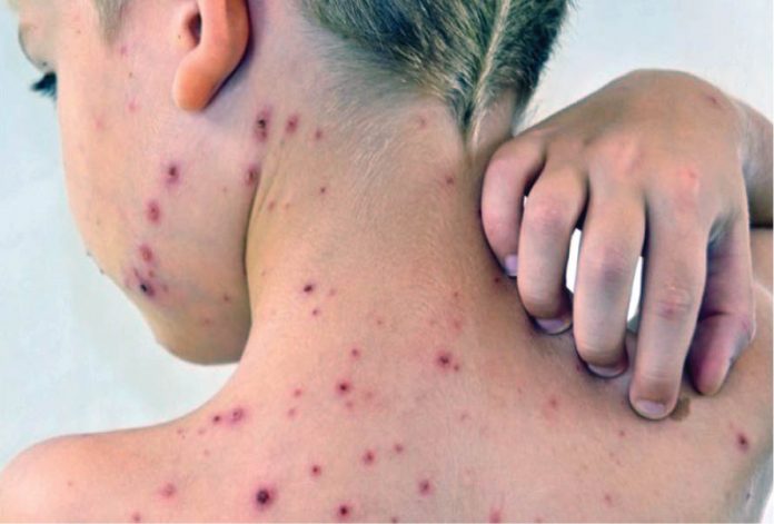 Numărul cazurilor de rujeolă scade, dar riscurile rămân ridicate