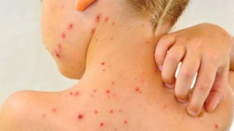România, lider european în cazurile de rujeolă din cauza dezinformării