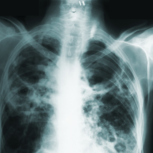 Un rezident din Camden County, izolat după ce a fost diagnosticat cu tuberculoză