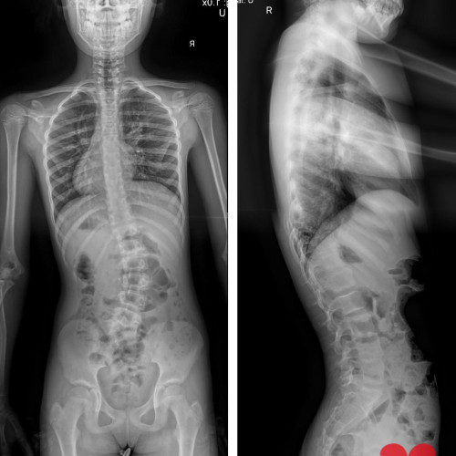 O fetiță de 10 ani caută ajutor pentru o intervenție chirurgicală esențială