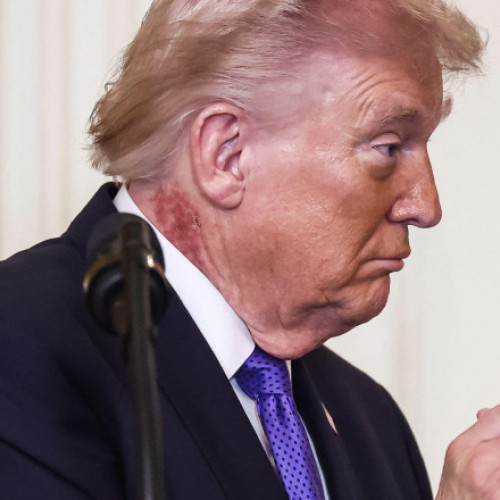 Noi întrebări despre starea de sănătate a lui Donald Trump. Ce este pata roșie apărută pe gâtul președintelui american