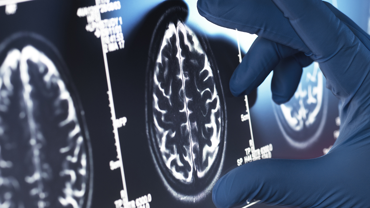 Viagara ar putea fi una dintre cele mai bune opțiuni existente pentru un tratament al Alzheimer