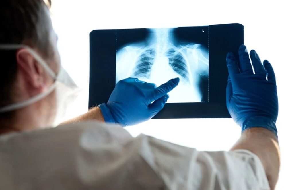 Peste 230 de persoane afectate de pneumonie în județ