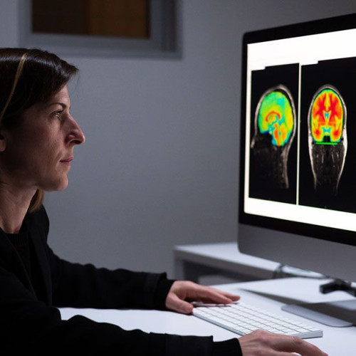 Un instrument AI prezice boala Alzheimer cu aproape 93% acuratețe folosind scanări cerebrale