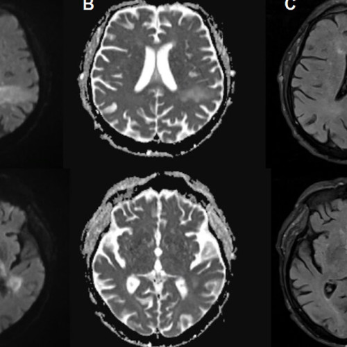 Un virus necunoscut ar putea deja să vă infecteze creierul