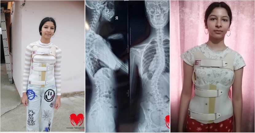 O adolescentă din Râmnicu Vâlcea are nevoie urgentă de ajutor pentru o operație