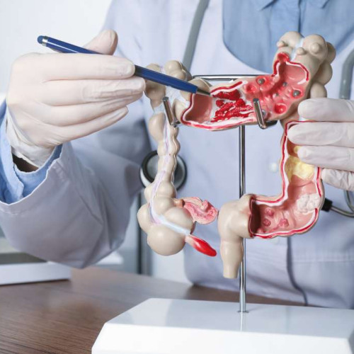 Cancerul colorectal, principala cauză a deceselor prin cancer sub 50 de ani