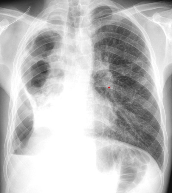Conferință dedicată luptării împotriva tuberculozei organizată la Galați