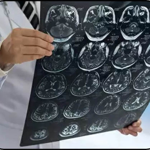 Meningita provoacă anual peste 250.000 de decese la nivel mondial