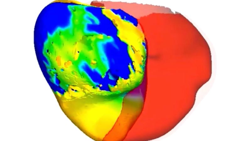 Medici folosesc replici digitale pentru a trata bătăile neregulate ale inimii