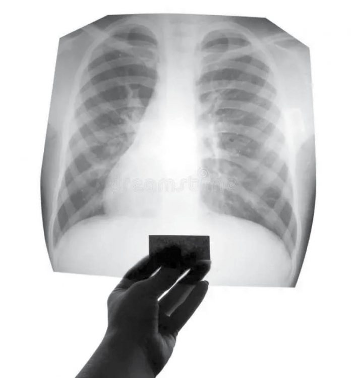 Campanie gratuită de screening pentru tuberculoză în Comarnic