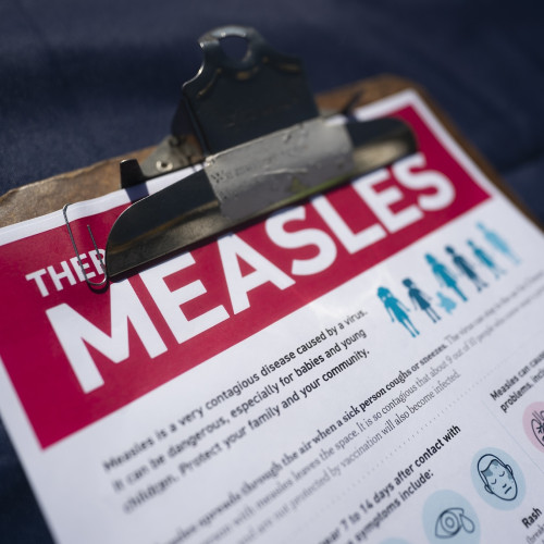 Measles will get worse before it gets better
