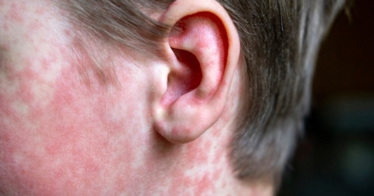 Maricopa County public health officials confirm measles exposure in Queen Creek, list locations - ABC15 Arizona
