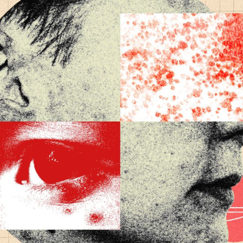 Trebuie să fii mai îngrijorat de herpesul zoster