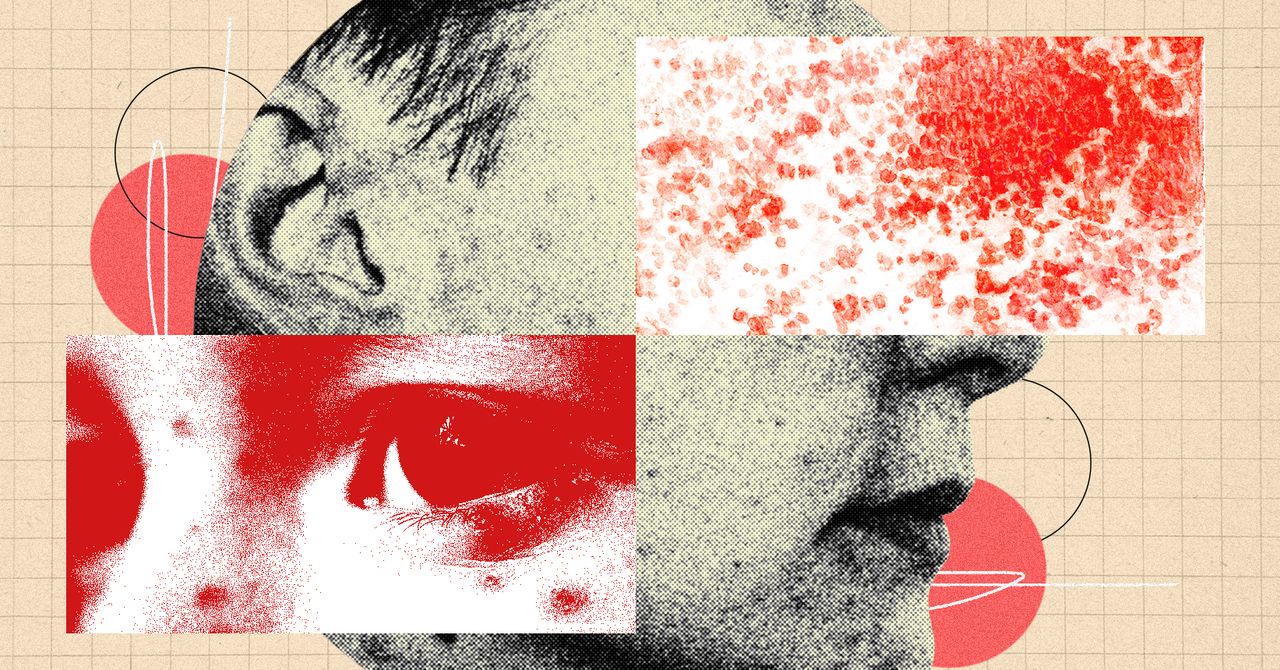 Trebuie să fii mai îngrijorat de zona zoster