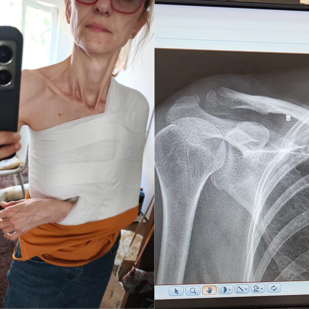 Accident grav în Târgu Jiu: o femeie rănită în zona pietonală