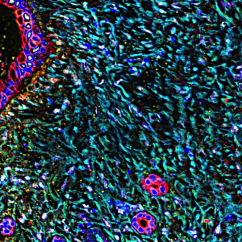 Erasca anunță rezultate puternice, deși preliminare, în studiul terapiei pentru cancerul pancreatic și pulmonar