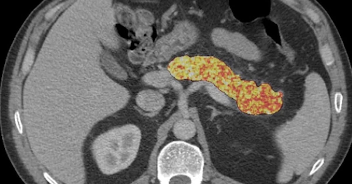 AI finds signs of pancreatic cancer before tumors develop - NBC News