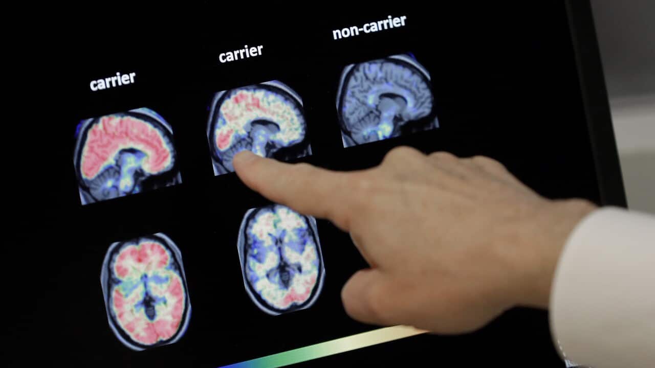 It's probably already in your fridge — and it could help in cutting risk of Alzheimer's - SBS Australia