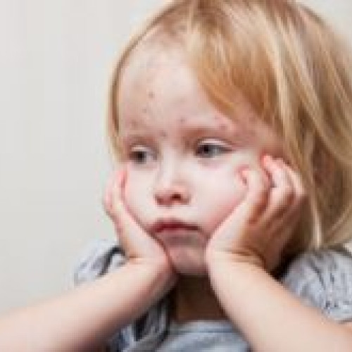 Rata cazurilor de rujeolă în județul Covasna a depășit 400 în primele luni ale anului