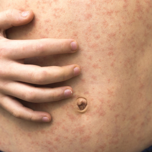 Alte două persoane raportate decedate din cauza rujeolei în ultima săptămână