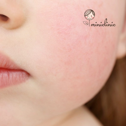 Eritemul infecțios răspândit în rândul copiilor din Mureș a provocat absența acestora de la școală și grădiniță