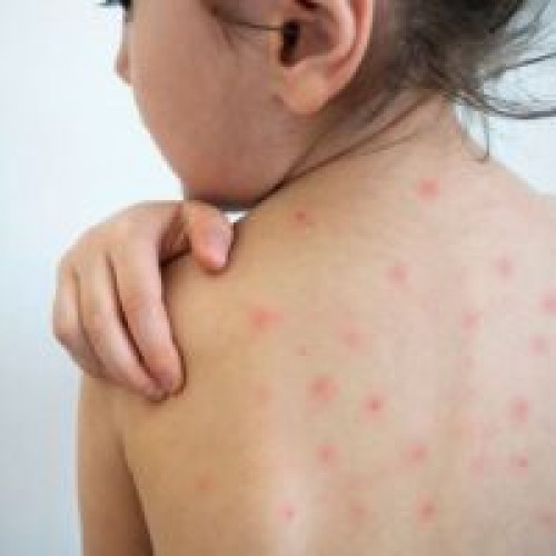 Record de cazuri noi de rujeolă: peste 900 în ultima săptămână