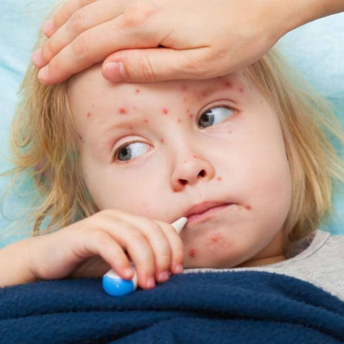 Rujeola se răspândește în România. Numărul îmbolnăvirilor crește și la Spitalul de Boli Infecțioase din Târgoviște.