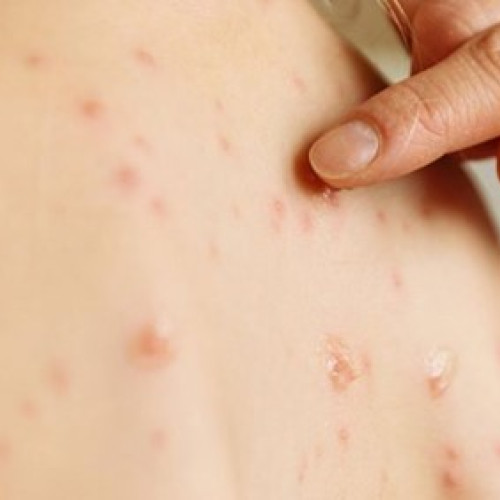 Saptamanal, 25 de cazuri de rujeola, mai putine in Mureș