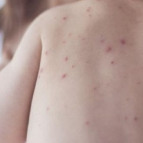 Alertă de rujeolă în Sf. Gheorghe: DSP huiduită de antivacciniști