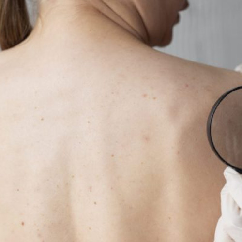 Campanie de depistare precoce a melanomului la Miercurea Ciuc