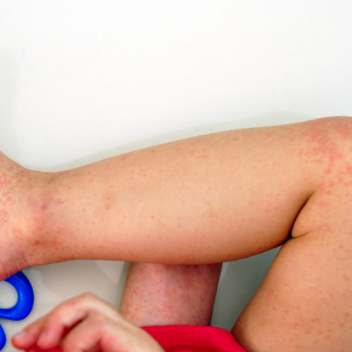 Epidemia de rujeolă în continuă creştere în România: Ministrul Sănătăţii face un apel la vaccinarea copiilor şi adulţilor nevaccinaţi sau neimunizaţi!
